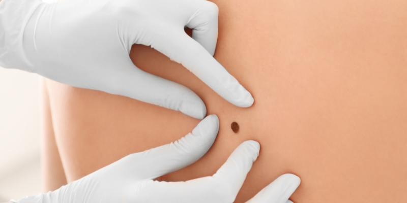 precio-tratamiento-oncologico-de-cancer-de-piel